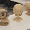 Een chirurg van Jan Portaels ontwikkelde samen met een Gents bedrijf een nieuwe kaakprothese